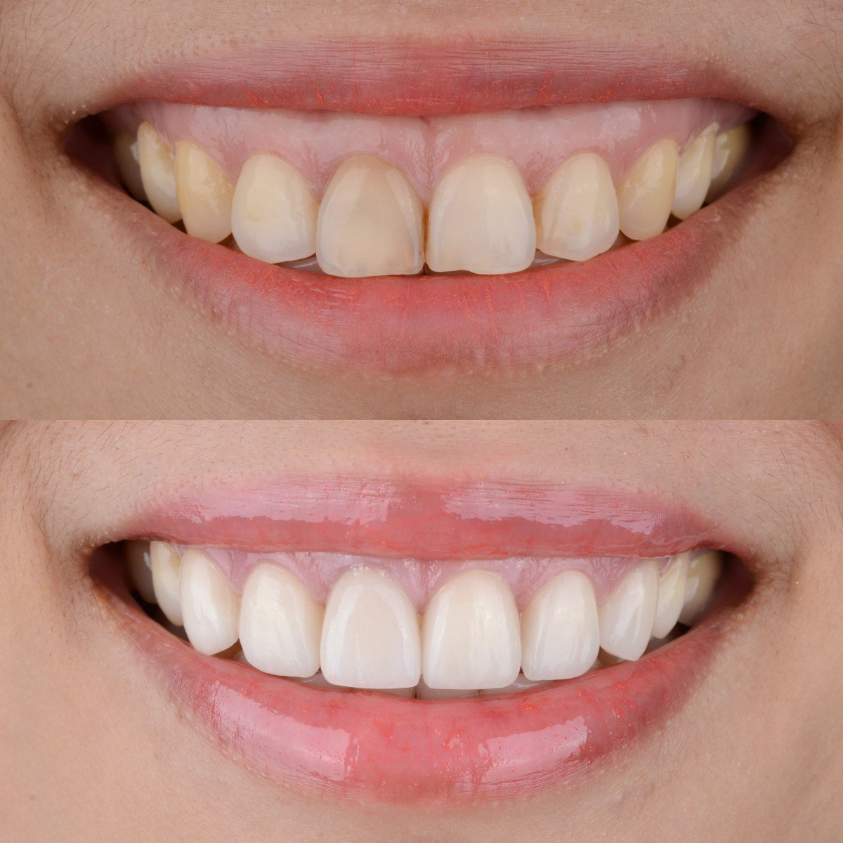 Smile,Makeover,Before,And,After,,Gummy,Smile,Correction,And,Ceramic